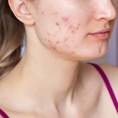 Acne